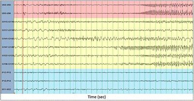 Large-Scale Desynchronization During Interictal Epileptic Discharges Recorded With Intracranial EEG